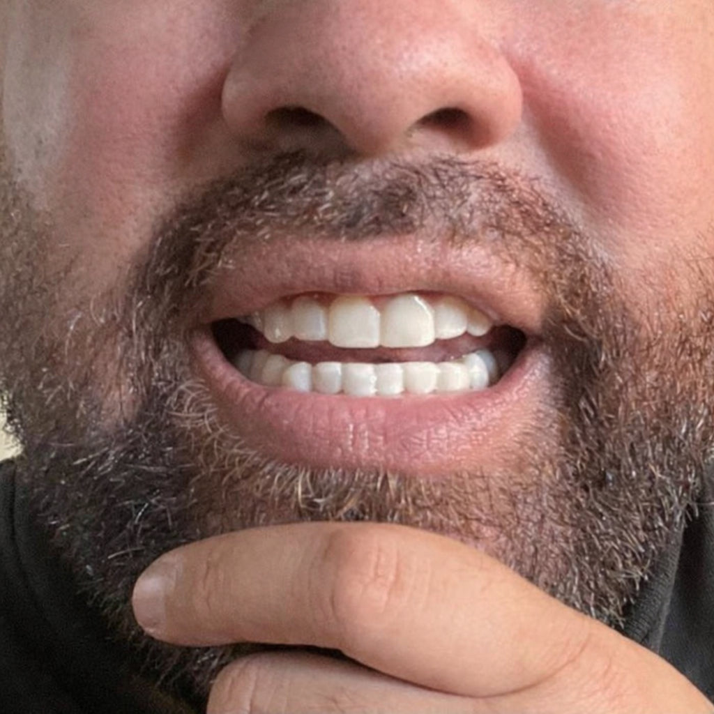 Shiny Smile Veneers: Are they really right for you?