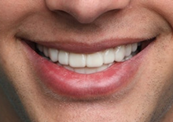 Why Natural white Veneers Are the Most Popular Choice