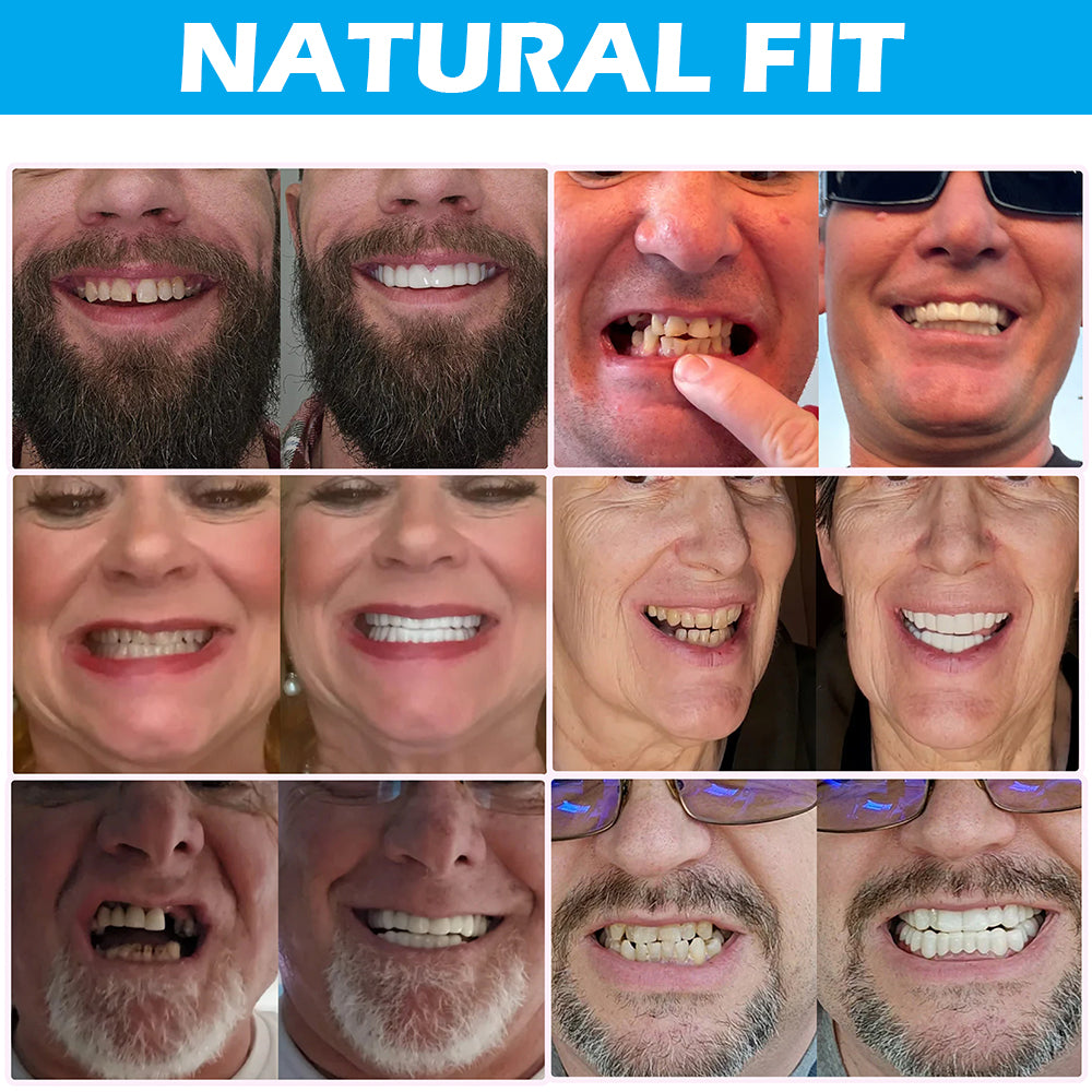 Either Top or Bottom Veneers